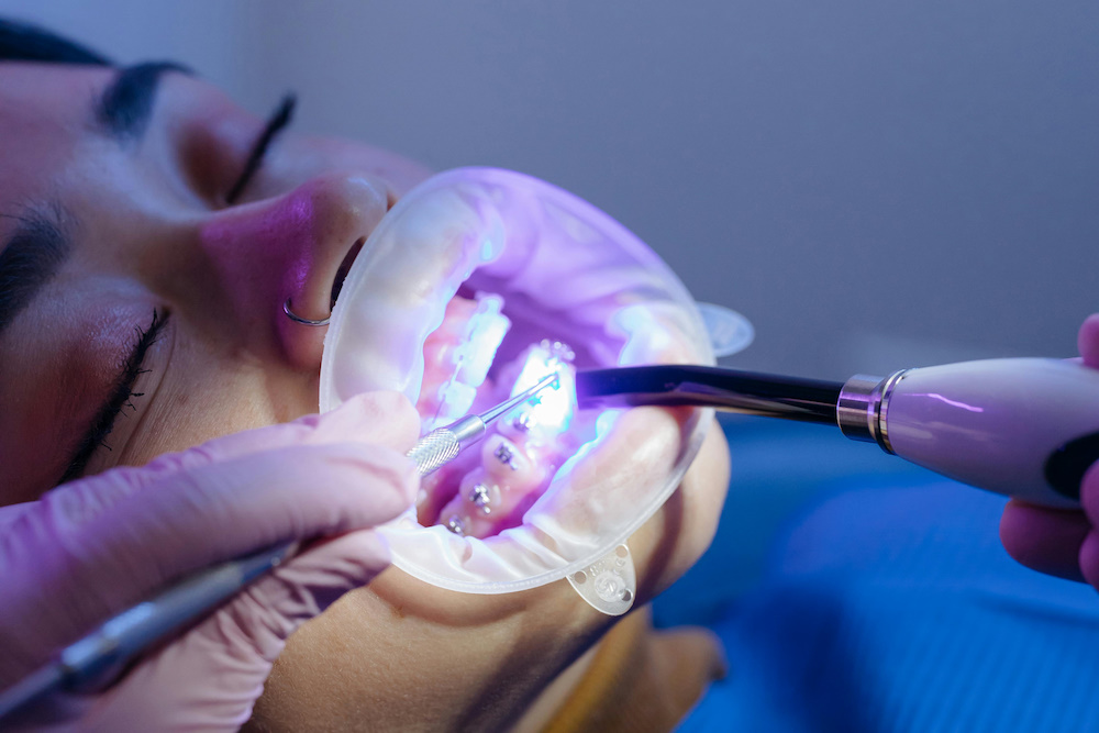 Ortodoncia con brackets y alineadores en UltraDental Lima