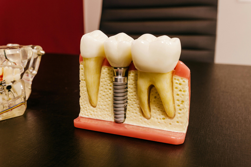 Implantes dentales seguros y duraderos en UltraDental Perú